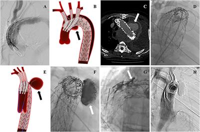 Chimney Graft Technique Combined With Embolization for Treating Ruptured Aortic Arch Lesions